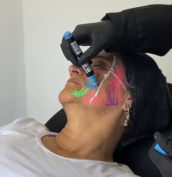 Dra Marina Carvalho aplicando Bioestimulador